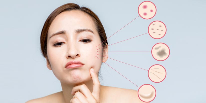 12 Foods That Trigger Pimple Breakouts